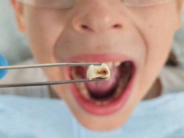 Best Emergency Dental Filling Replacement  in Richfield, OH