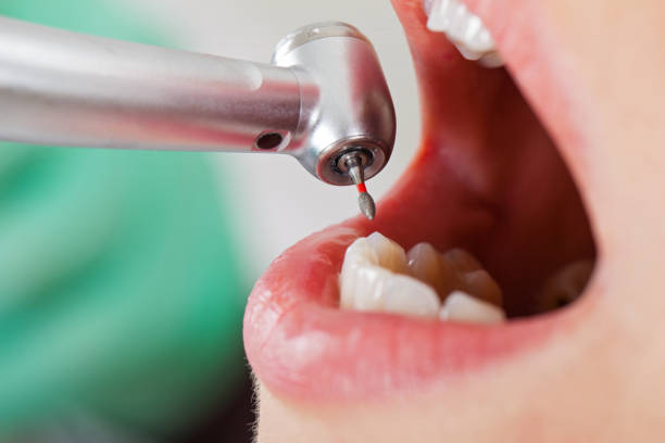 Best Root Canal Emergency Dentist  in Richfield, OH